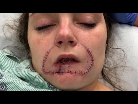 Woman Gets Surgery to Restore Lip Her Ex-Boyfriend Bit Off