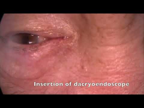 Lacrimal duct parameters based on dacryocystography - Supplementary video [ID 370800]